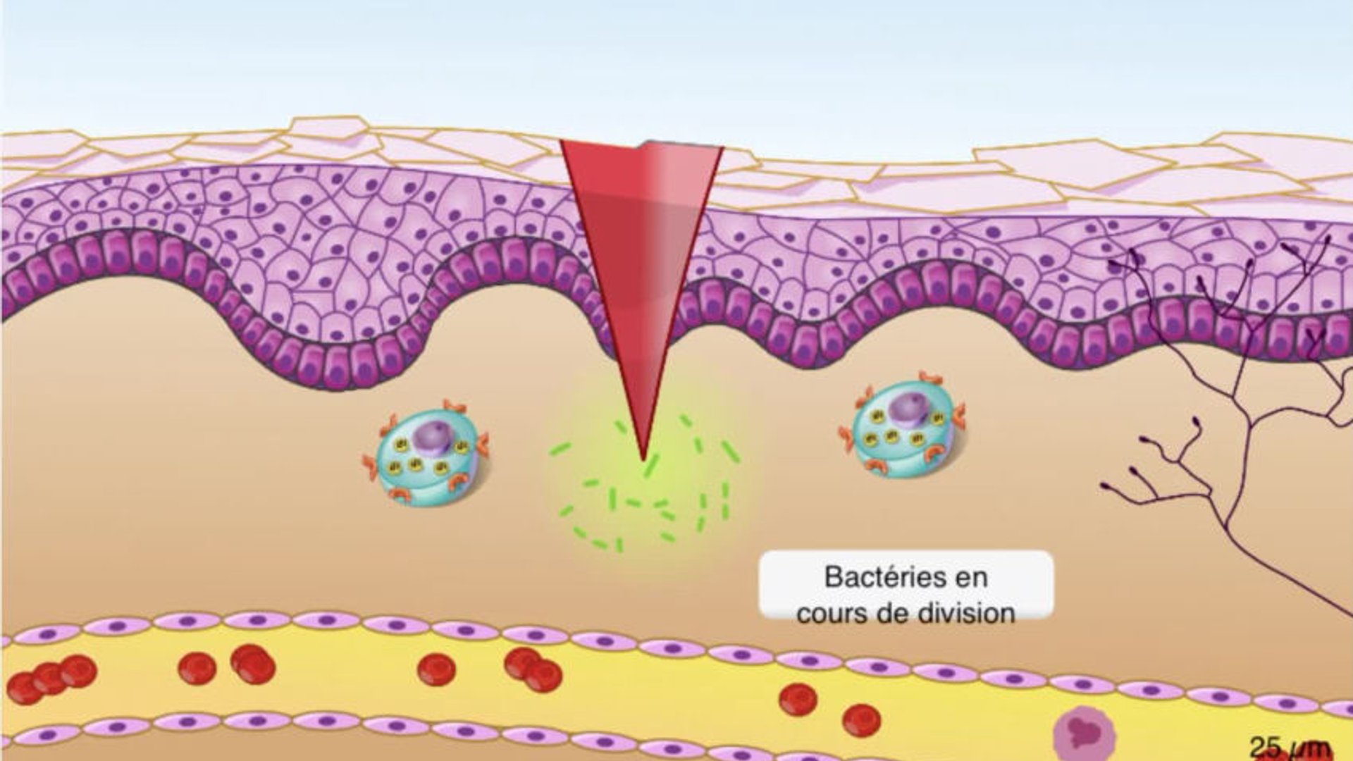 La réaction inflammatoire - Sciences & Technologies